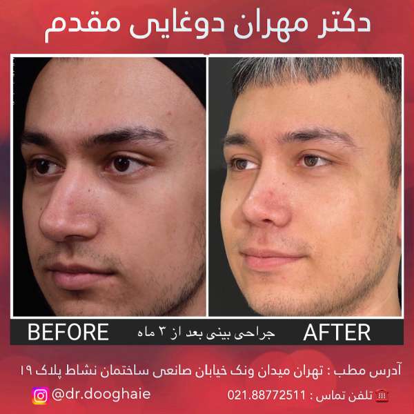 جراحی بینی مردانه