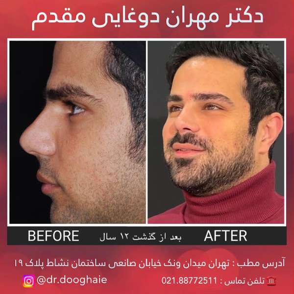 مدل بینی مردانه