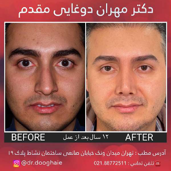 عمل بینی مردانه