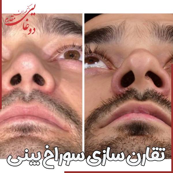 تقارن سازی سوراخ های بنیی