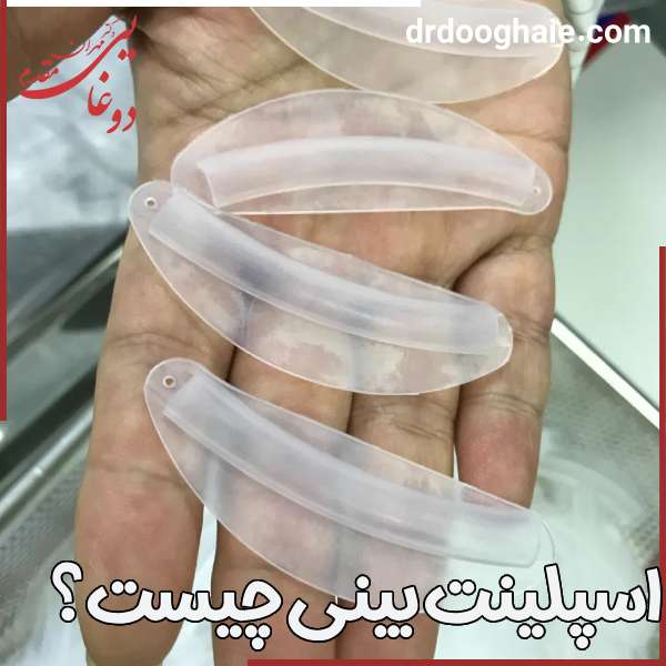اسپلینت بینی چیست