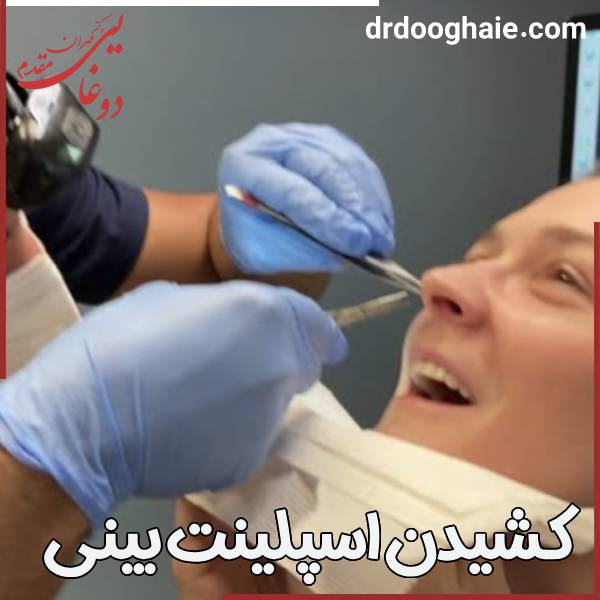 عکس کشیدن اسپلینت بینی