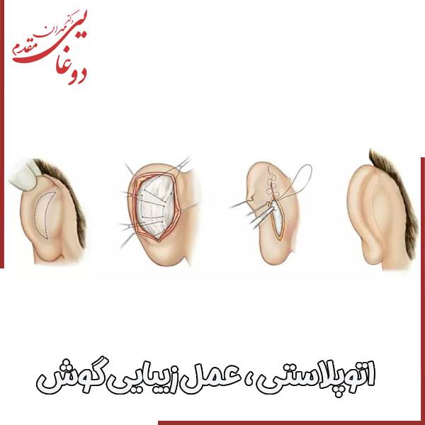 عکس عمل زیبایی گوش