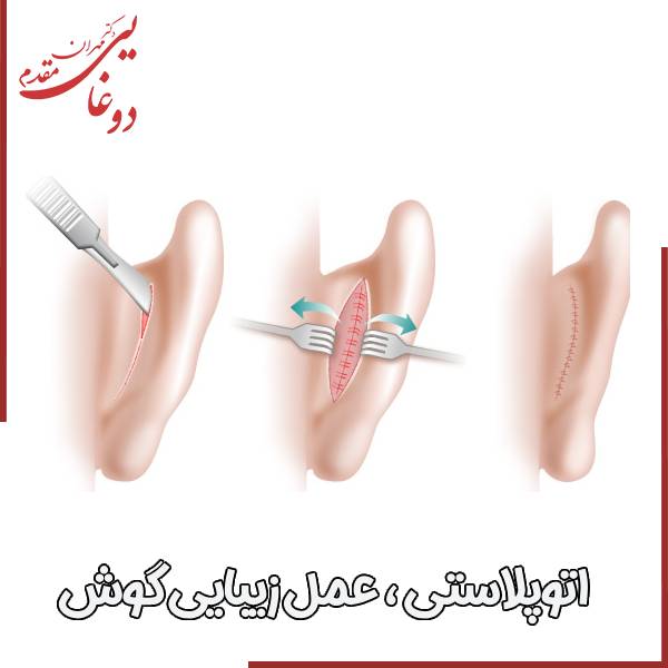 عکس اتوپلاستی