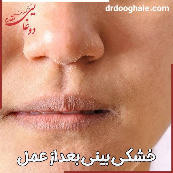 خشکی بینی بعد از جراحی
