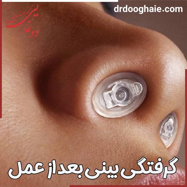 علت گرفتگی بینی بعد از عمل 