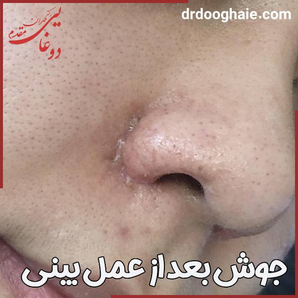 عکس جوش سرسیاه بعد از جراحی بینی