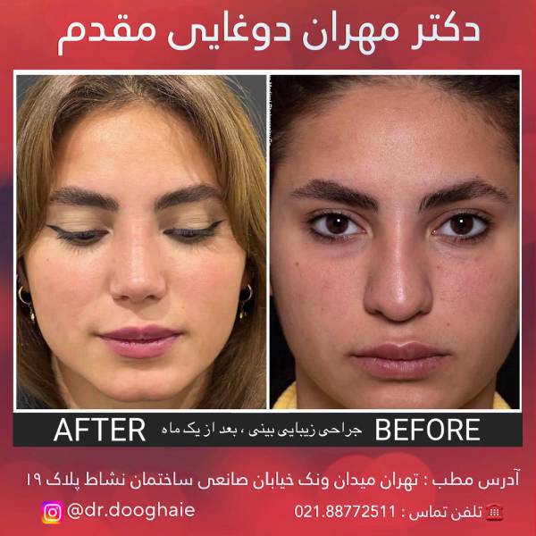 عکس عمل بینی گوشتی