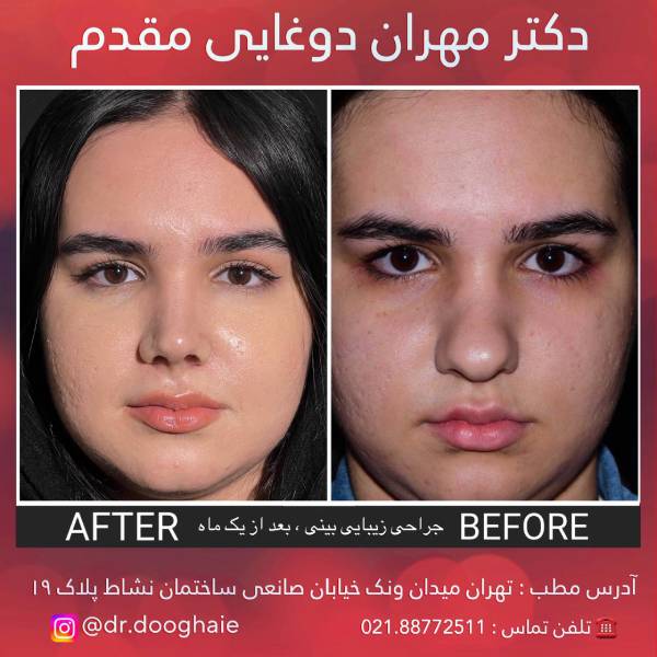 عکس عمل بینی گوشتی