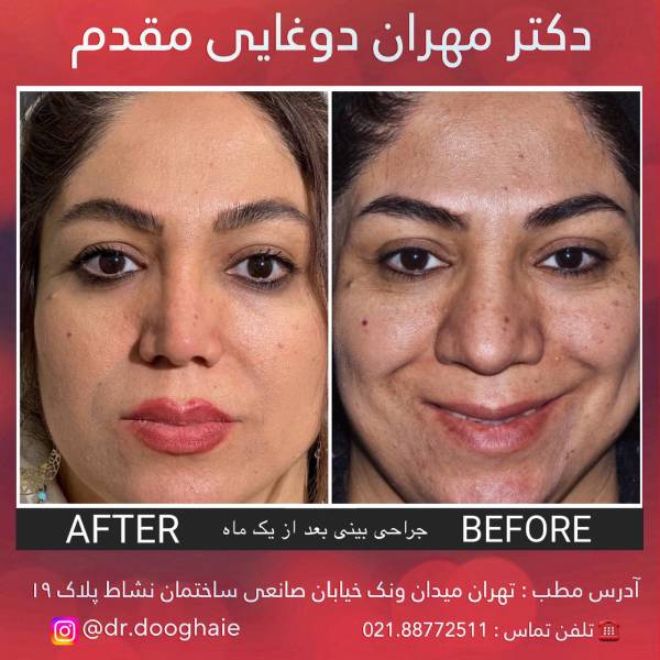 عکس بینی گوشتی با پوست ضخیم