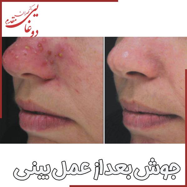 جوش بعد از جراحی بینی