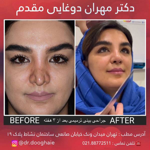 جراحی بینی منگنه ای