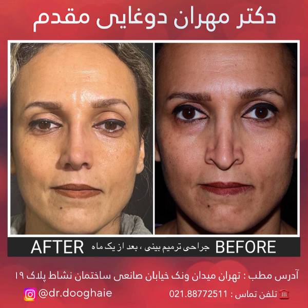 عمل بینی منگنه ای