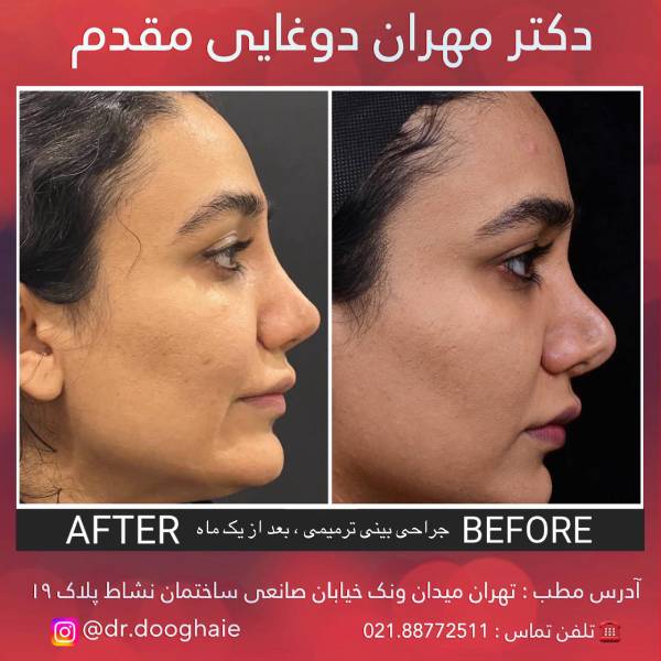 عکس بینی منگنه ای