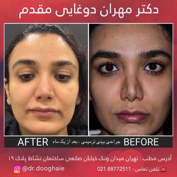 عمل بینی کلیپسی