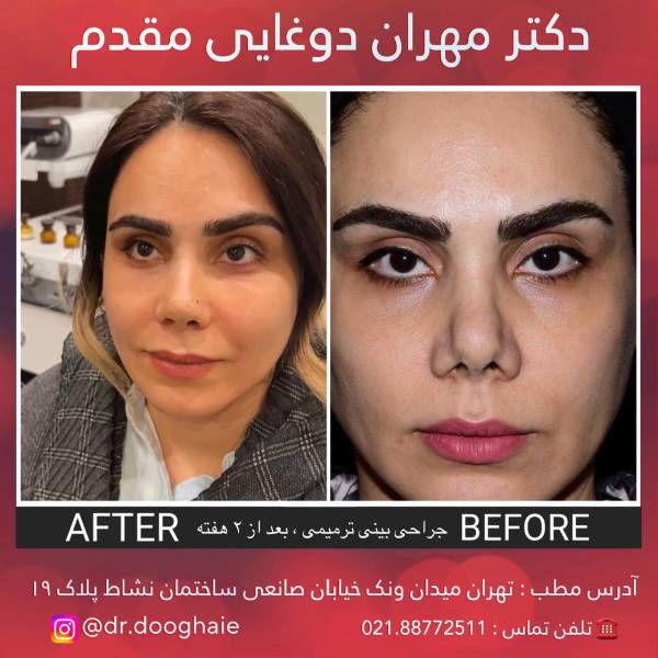 عمل فرو رفتگی پره بینی