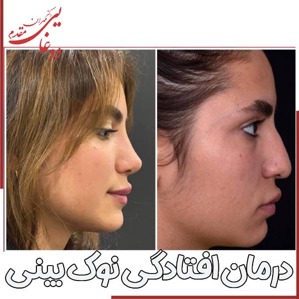 درمان افتادگی بینی بعد از عمل
