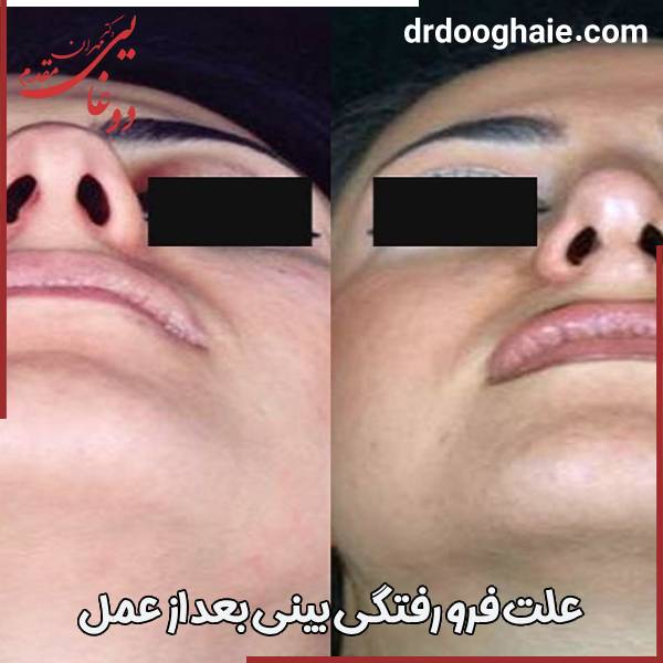 علت فرو رفتگی بینی بعد از عمل