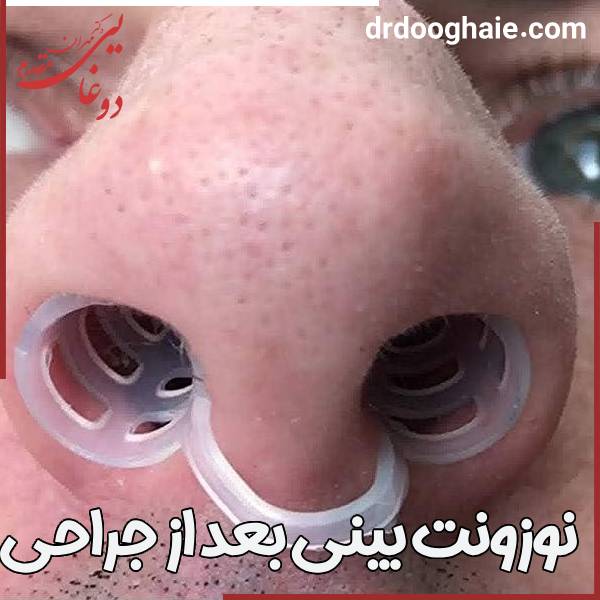 عکس نوزونت بینی