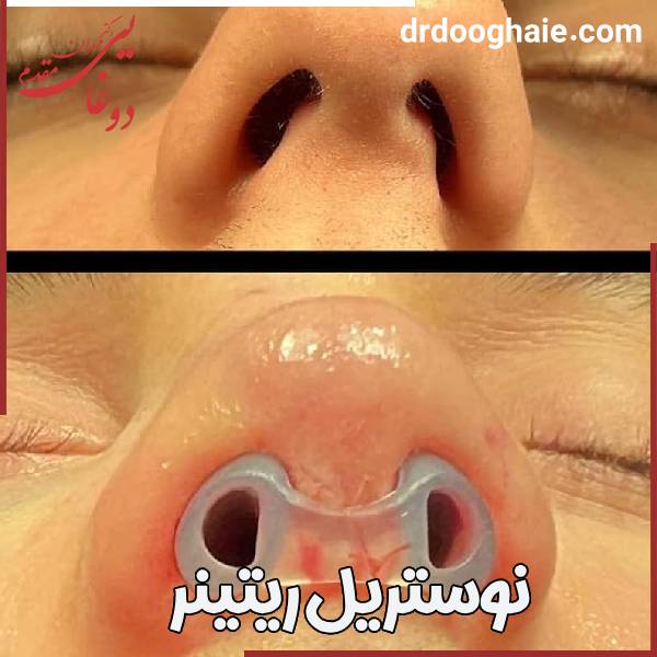 نوستریل ریتینر