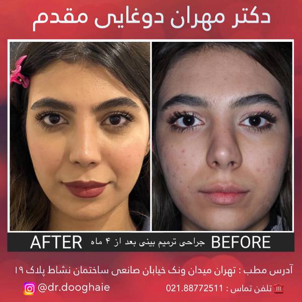عکس نمونه عکل بینی بهترین جراح بینی در تهران