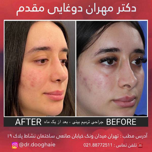 عکس نمونه عکل بینی بهترین جراح بینی در تهران