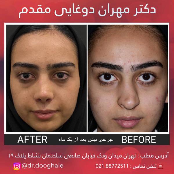عکس نمونه کار بهترین جراح بینی در تهران
